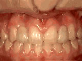 missing-lateral-incisors-after